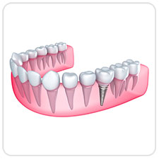 dental-implants-west-village-dental-toronto
