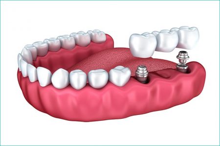implant supported dental bridge triassi west village dental