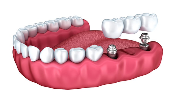 dental bridge in toronto dentist st clair west village dental