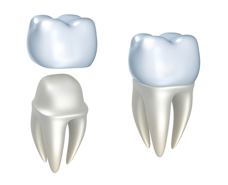 What Is A Dental Crown & Do You Need One?