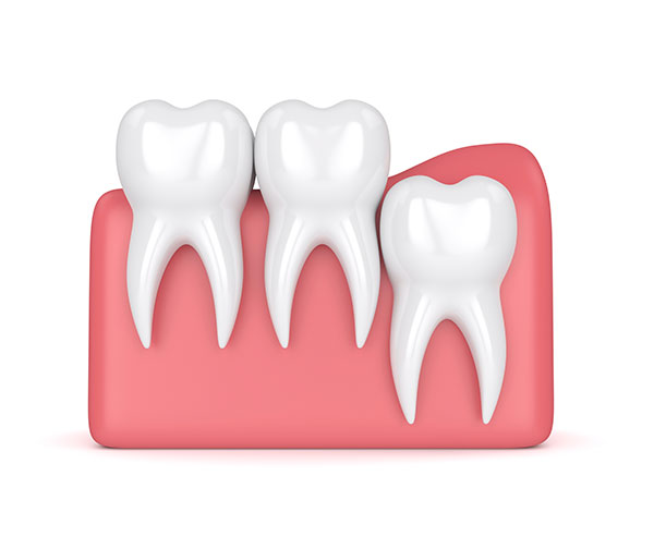 Everything You Need To Know About Wisdom Teeth