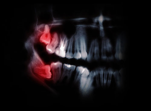 wisdom teeth xray toronto dentist