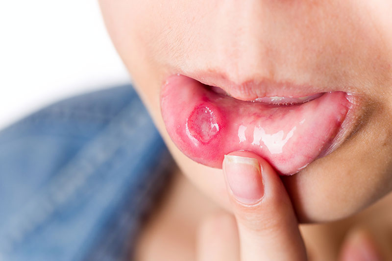 how to get rid of canker sores under tongue