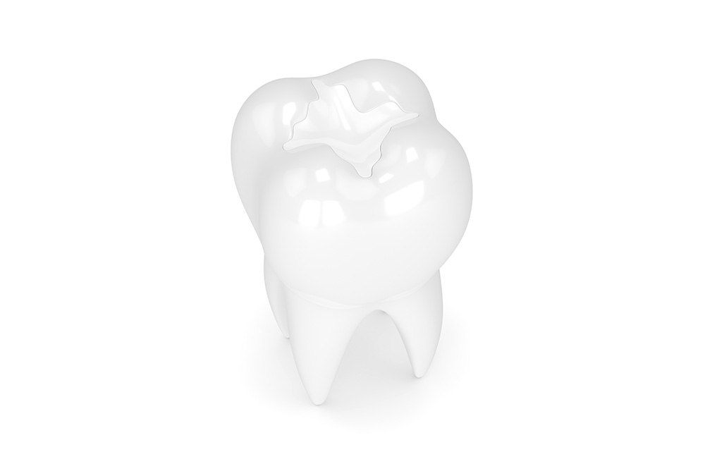 what are dental sealants toronto dentist