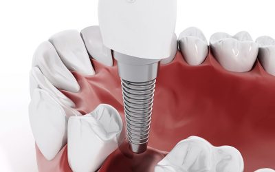 How Can Dental Implants Benefit Your Smile?