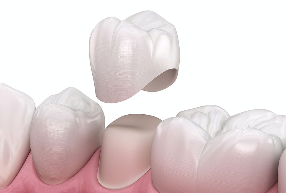 dental crown in toronto dentist st clair