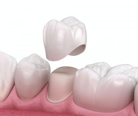dental crown in toronto dentist st clair