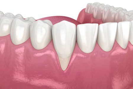 how to fix low gums dentist in toronto