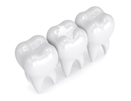 does my child need dental sealants toronto dentist