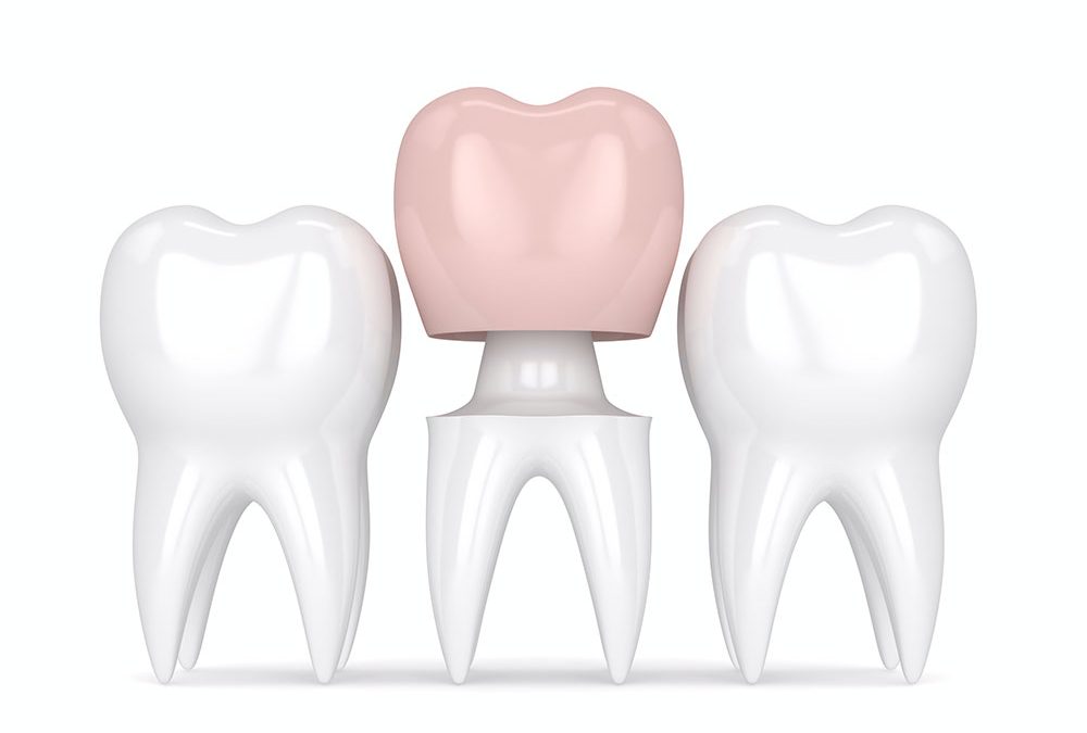 Four Benefits of Dental Crowns