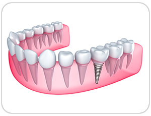 dental implants toronto - west village dental - triassi