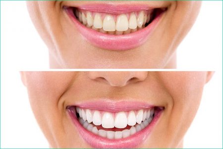 teeth whitening bleaching zoom-west-village-dental-toronto-st-clair