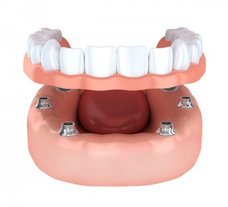 implant supported denture toronto on dentist