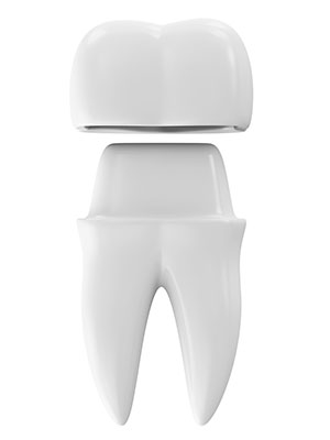 dental crown toronto dentist st clair