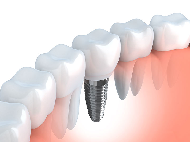 Benefits Of Choosing Dental Implants