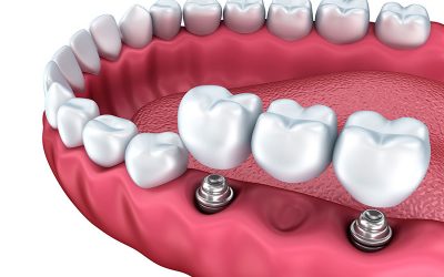Learn All About Dental Bridges