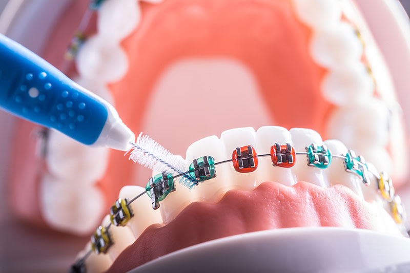 clean dental braces brush dentist