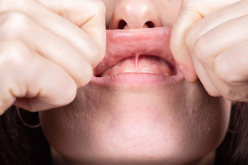 Treat A Tongue Tie With Frenectomy Treatment