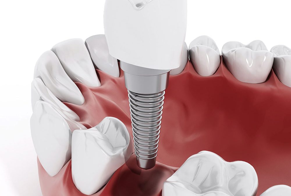 How Can Dental Implants Benefit Your Smile?